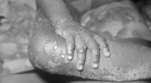 Leia mais sobre o artigo Amazonas confirma quinto caso de varíola dos macacos