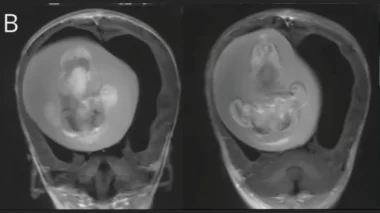 Criança passa por cirurgia para remover feto do irmão do crânio