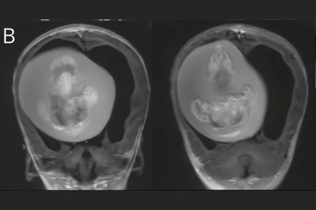 Você está visualizando atualmente Criança passa por cirurgia para remover feto do irmão do crânio