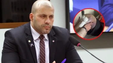 Advogado mostra foto da perna de Daniel Silveira após cirurgia