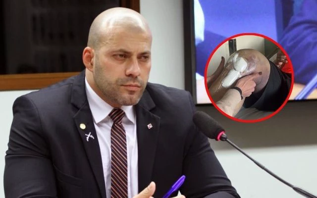 No momento, você está visualizando Advogado mostra foto da perna de Daniel Silveira após cirurgia